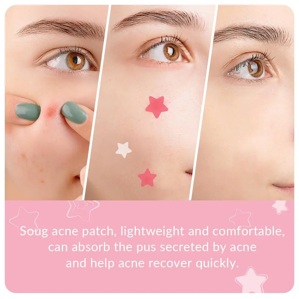 SOUG 240Pcs Cute Star Acne/Pimple Patch Acne Treatment Stickers Invisible Acne Stars Cover Face Spot Removal Pimple Skin Care